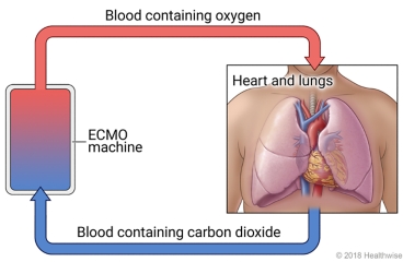 Diagram of blood containing carbon dioxide leaving body, passing through ECMO machine, and returning to body with oxygen.