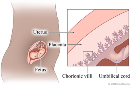 Fetus in uterus, with detail of placenta showing the chorionic villi and umbilical cord