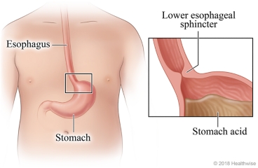 Location of lower esophageal sphincter between esophagus and stomach, with detail of the sphincter and stomach acid
