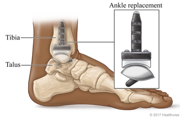 Lower leg and foot, showing tibia, talus, and artificial ankle replacement.