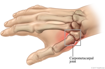 Skeletal view of arthritis in the carpometacarpal joint