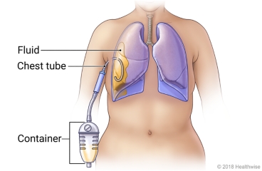 Lungs in chest, showing chest tube inserted to space around lung to drain fluid into container.