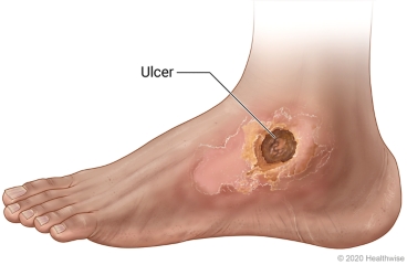 Foot with arterial skin ulcer over ankle bone.