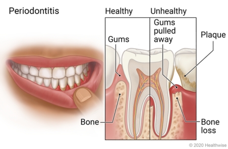 Mouth with plaque on teeth and unhealthy gums, with detail of advanced gum disease showing plaque, gums pulled away, and bone loss.
