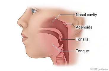 Side view of child's head and neck, showing nasal cavity, tongue, and tonsils, with adenoids at back of nasal cavity.