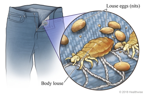 Body lice in seam of pants, with close-up of body lice and eggs (nits).
