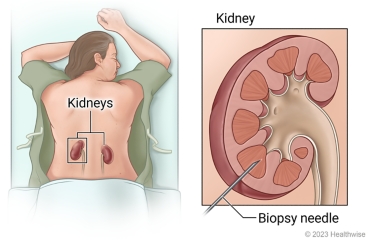 Location of kidneys in lower back, with detail showing biopsy needle put into kidney for biopsy.