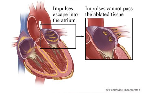 How scar tissue from ablation stops electrical impulses.