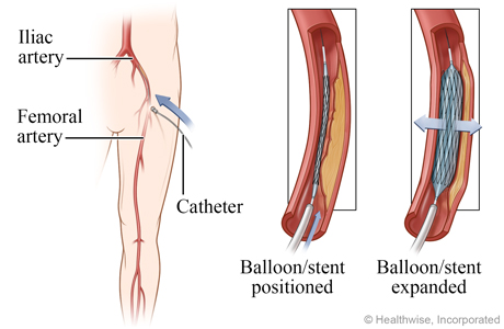 Balloon and stent positioned and expanded