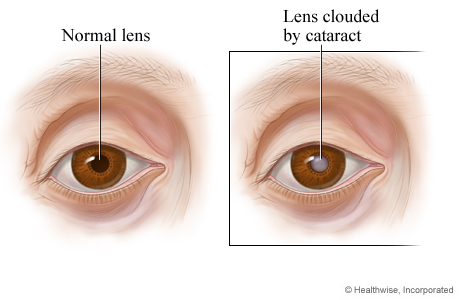 A normal lens compared to a lens clouded by a cataract