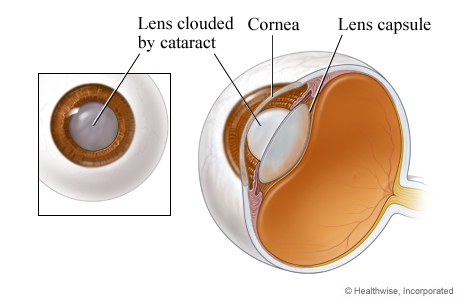 An eye lens clouded by a cataract (close-up)