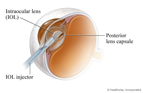 An intraocular lens being placed during cataract surgery