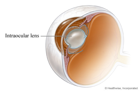 An intraocular lens in place after cataract surgery