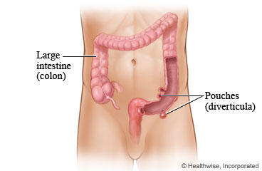 Pouches called diverticula in the large intestine