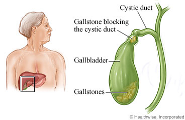 Gallstone in cystic duct