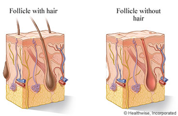 Hair follicles with and without hair