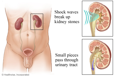 How lithotripsy for kidney stones works