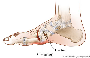 Picture of problems caused by charcot foot