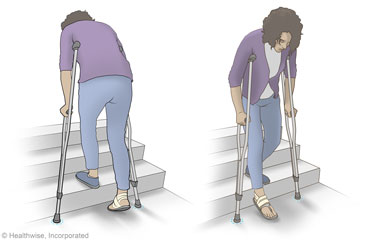 Person going up and down stairs using crutches.