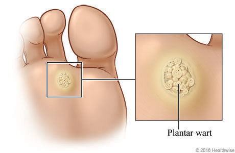 Plantar wart on bottom of foot below toes with close-up of raised and bumpy wart.