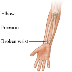 The arm bones and a broken wrist