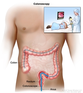 Colonoscopy; drawing shows a colonoscope inserted through the anus and rectum and into the colon. An inset shows a patient lying on a table having a colonoscopy.