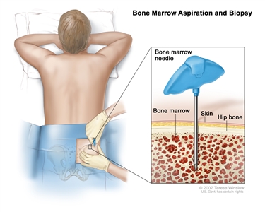 Bone marrow aspiration and biopsy; drawing shows a patient lying face down on a table and a bone marrow needle being inserted into the hip bone. Inset shows the bone marrow needle being inserted through the skin into the bone marrow of the hip bone.