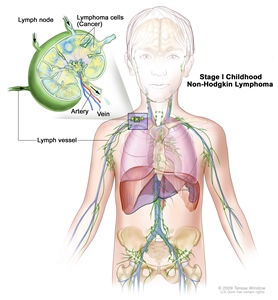 Stage I childhood non-Hodgkin lymphoma; drawing shows cancer in one group of lymph nodes. An inset shows a lymph node with a lymph vessel, an artery, and a vein. Lymphoma cells containing cancer are shown in the lymph node.