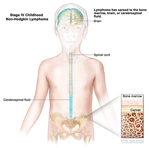 Stage IV childhood non-Hodgkin lymphoma; drawing shows the brain, spinal cord, and cerebrospinal fluid in and around the brain and spinal cord. An inset shows cancer in the bone marrow.