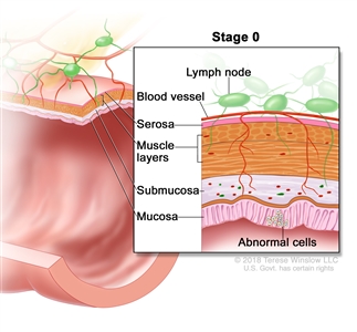 Stage 0 colorectal carcinoma in situ; drawing shows a cross-section of the colon/rectum. An inset shows the layers of the colon/rectum wall with abnormal cells in the mucosa layer. Also shown are the submucosa, muscle layers, serosa, a blood vessel, and lymph nodes.