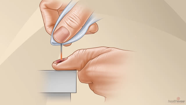 How to Drain Blood From Under a Nail