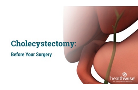 Cholecystectomy: Before Your Surgery