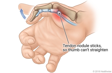 Inside view of the thumb, showing the bones and the tendon nodule that sticks so the thumb can't straighten