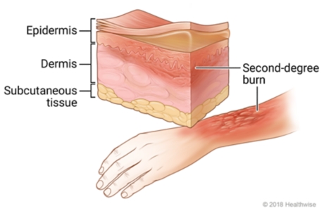 Second-degree burn on arm, with cross-section of skin showing redness and swelling in top two skin layers.