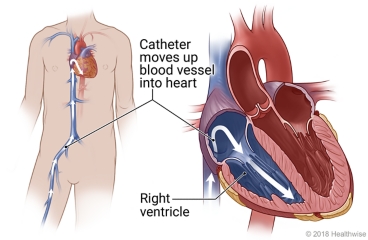 Catheter moves through blood vessel from groin to heart's right ventricle, with detail of right ventricle