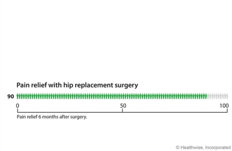 Six months after hip replacement, about 90 out of 100 people have less pain than before the surgery