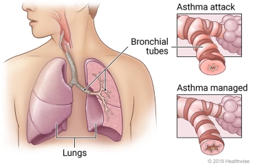 Lungs in chest showing bronchial tubes in left lung, with detail of bronchial tube affected by asthma attack compared to one with managed asthma