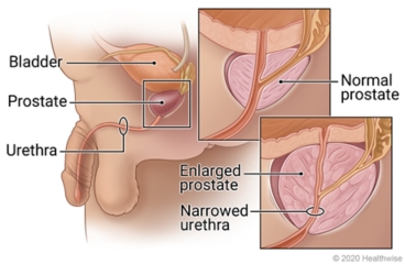 Location of prostate below bladder, with detail of urethra in normal prostate and narrowed urethra in enlarged prostate.