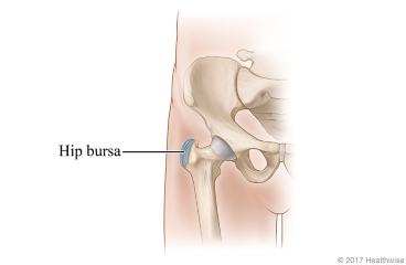 Location of the bursa at the outside of the hip