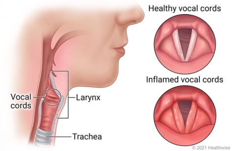 Location of larynx, vocal cords, and trachea in throat, with details of healthy vocal cords and inflamed vocal cords.