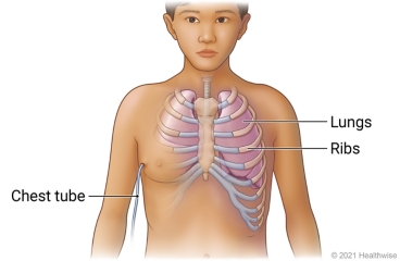 Ribs and lungs in chest, showing placement of chest tube at side of chest.