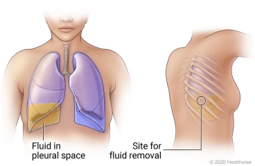 Lungs in chest showing fluid in right lung pleural space, and view of person's back showing site between two ribs for fluid removal.