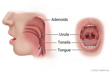 Side and open-mouth views of mouth and throat, showing adenoids, uvula, tonsils, and tongue.