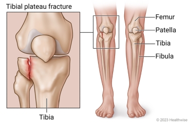 Bones of leg, including femur, patella, tibia, and fibula, with detail of broken tibia in tibial plateau fracture.