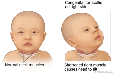 Baby with normal neck muscles, compared to baby with congenital torticollis, with shortened neck muscle on right side causing head to tilt up to left.