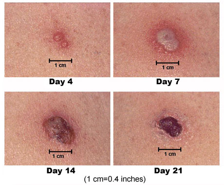 Typical skin reaction at the site of a smallpox vaccine injection
