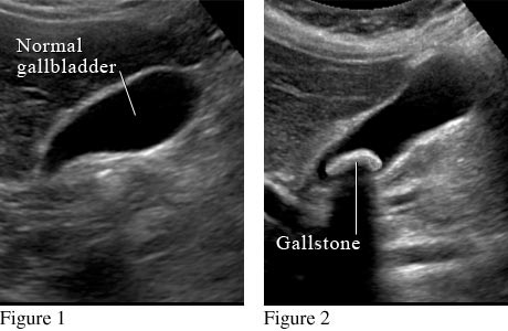 Abdominal ultrasound of gallbladder
