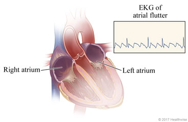Right and left atria of heart, with example of EKG reading of atrial flutter