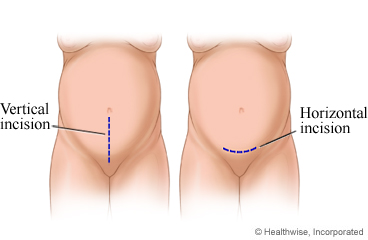 Cesarean incisions, both vertical and horizontal