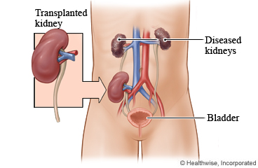 Diseased and transplanted kidneys